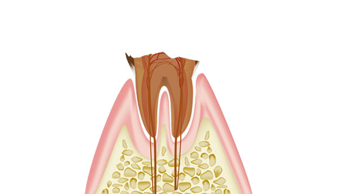 歯根に達した虫歯